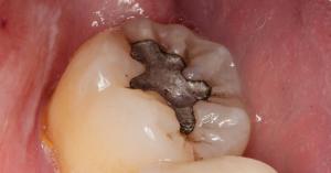 A dental amalgam filling, made of roughly 50% elemental mercury